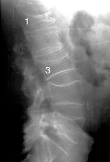 Osteoporosis Spine