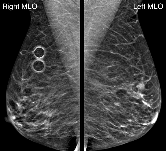 Mammogram.
