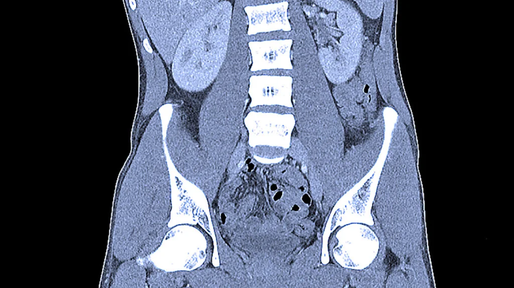 Ct Abdomen.