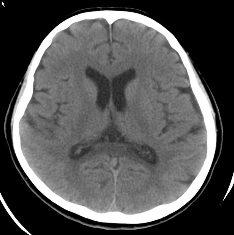 CT Noncontrast.