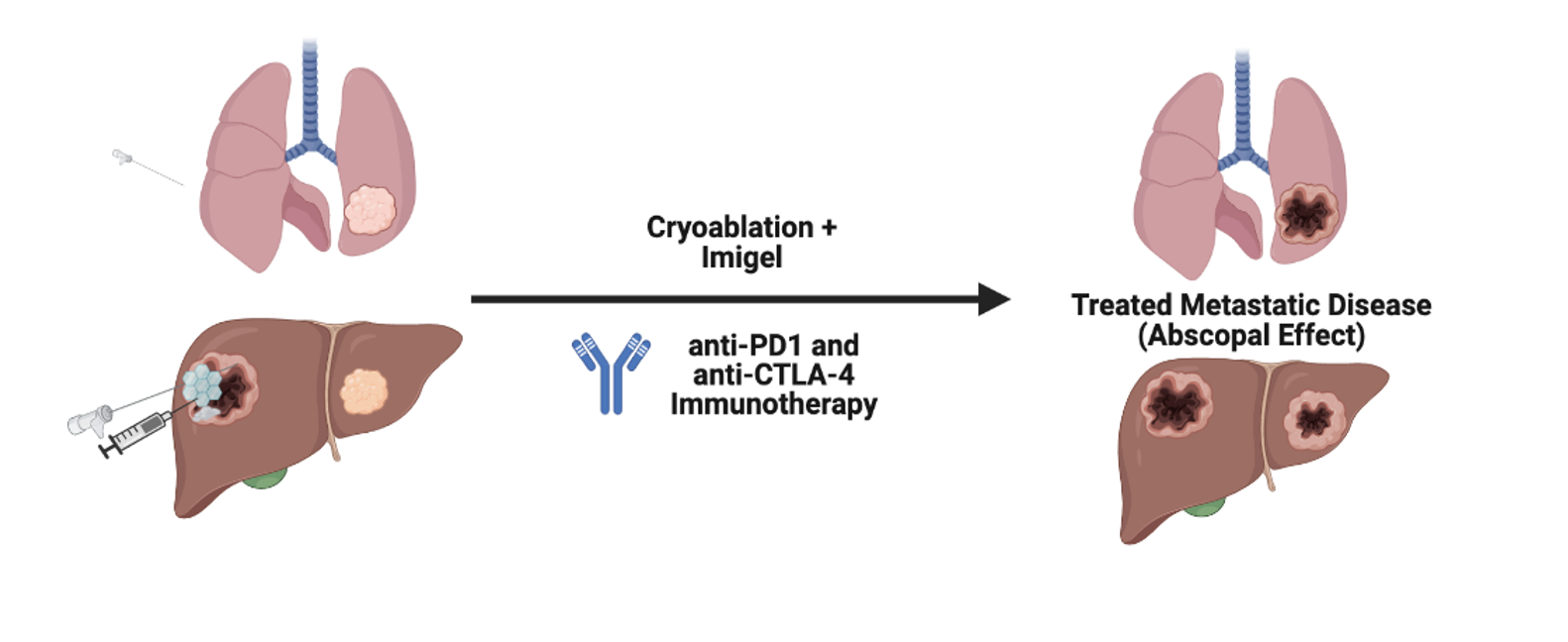 Schematic displaying the usage of Imigel as a thermoresponsive gel for cancer therapies. Local treatments leading to systemic responses.