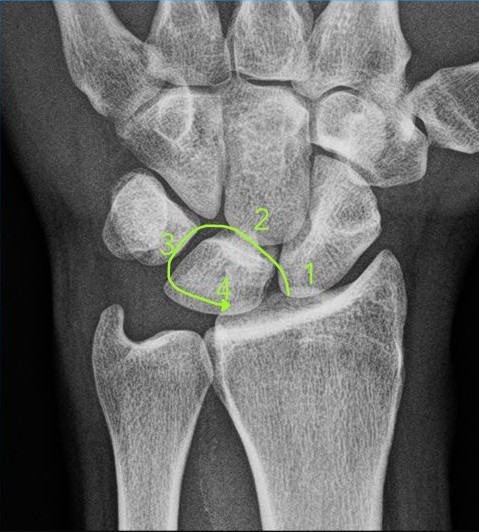 Wrist xray.