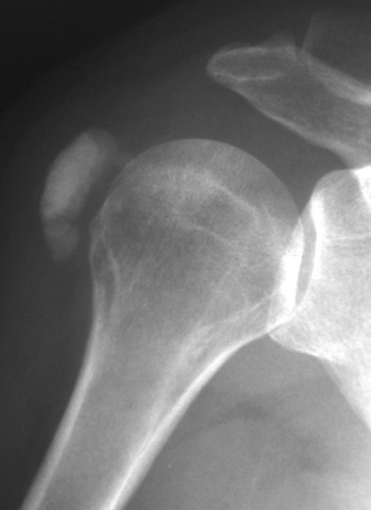 Shoulder Ca Tendinitis Small.