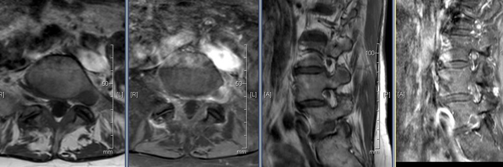 T1 axial pre and post Gad at L5/S1 leve         T1 sagittal pre and post Gad at left side.