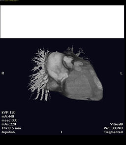 CT_coronary_artery_right_ventricle_fistula (1)