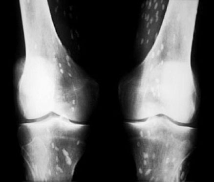 Radiological identification and analysis of soft tissue musculoskeletal  calcifications, Insights into Imaging