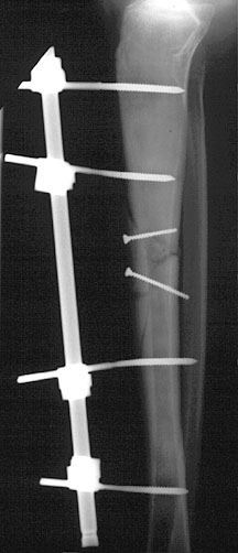 External Fix Tibia