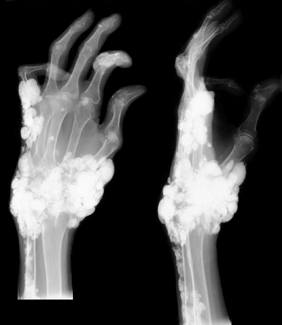 Radiological identification and analysis of soft tissue musculoskeletal  calcifications, Insights into Imaging