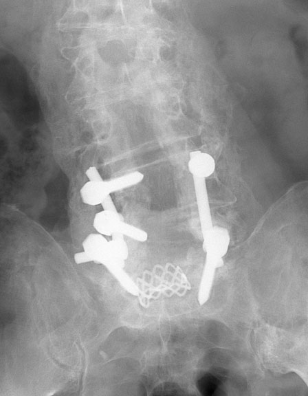 Post Spinal Rods AP