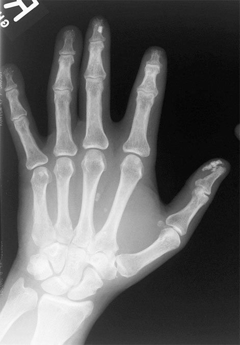 Metaphysis, Radiology Reference Article