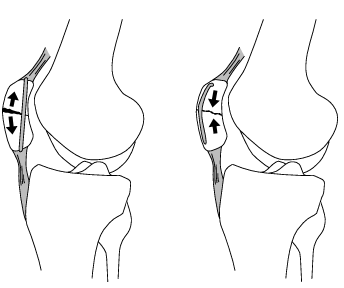 Tension Band Knee