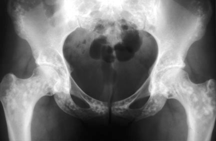 osteopoikilosis pelvis