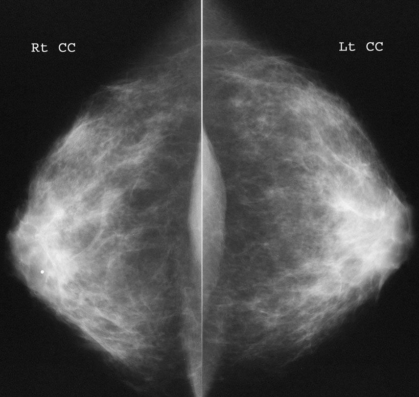 Маммография молочных желез 4. Фиброаденома молочной железы маммография. Фиброзно кистозная мастопатия молочной железы bi-rads-4a. Маммография молочных bi-rads 2. Маммография снимок в норме.