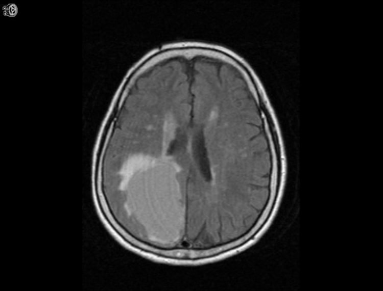 77 year-old with recent syncopal episode | UW Radiology