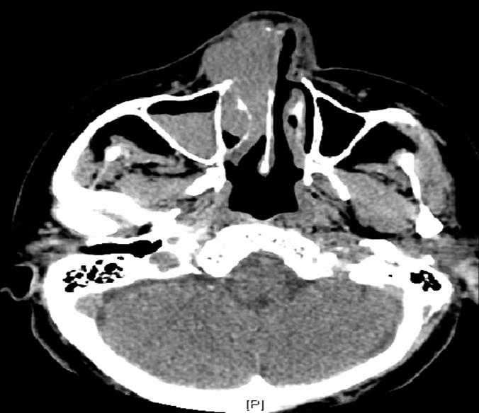 85 year-old with enlarging growth on right side of nose