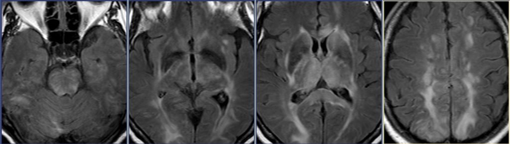 60 year old with bilateral lung transplants presents with new seizures ...