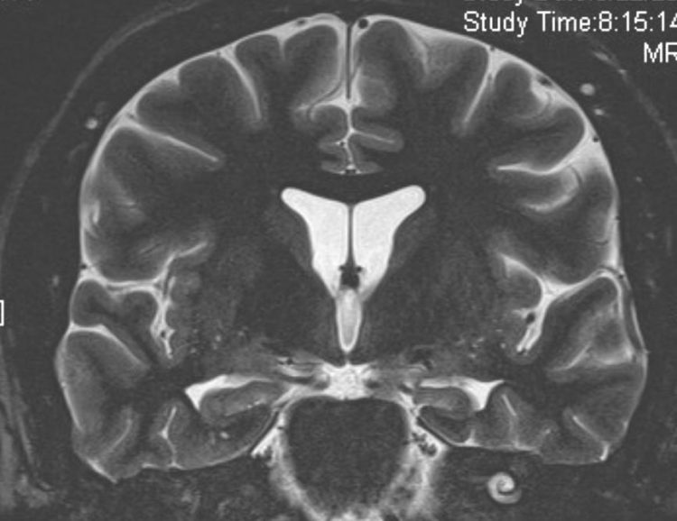 37 year-old with intractable epilepsy and inconclusive EEG | UW Radiology