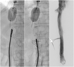 Inferior Vena Cava (IVC) Filters | UW Radiology