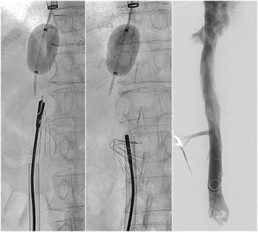 Inferior Vena Cava (IVC) Filters | UW Radiology