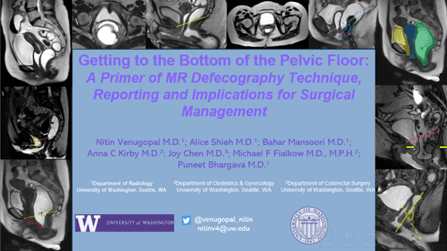 Getting to the Bottom of the Pelvic Floor: A Primer on MR Defecography Technique, Reporting and Implications for Surgical Management
Nitin Venugopal, MD