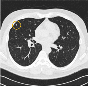 Black and white radiology image, showing unexpected finding which has a yellow circle around it. 